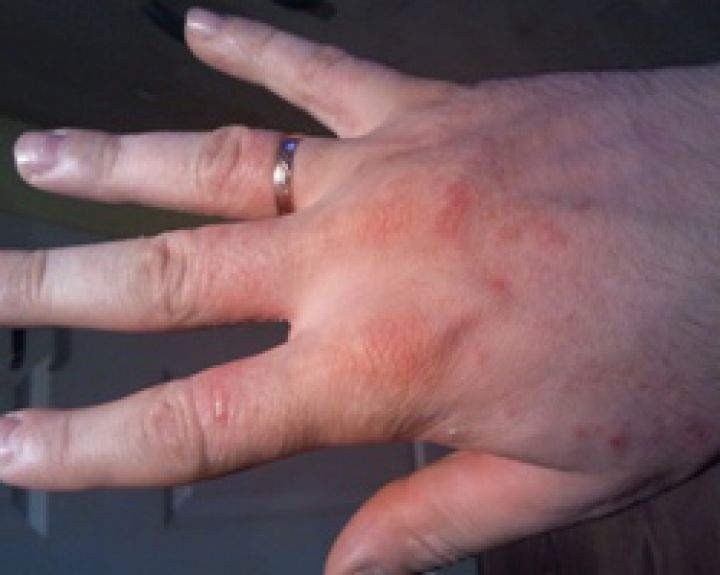 odos ligos ant rankų dėl kremzlių audinių regeneracijos