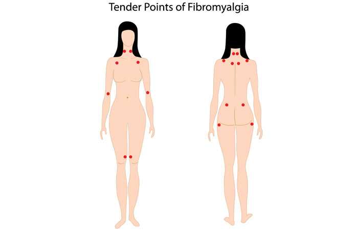 fibromialgija taskai