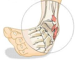 uždegimas pėdos pėdos artritas 2 laipsnių alkūnės sąnario gydymo