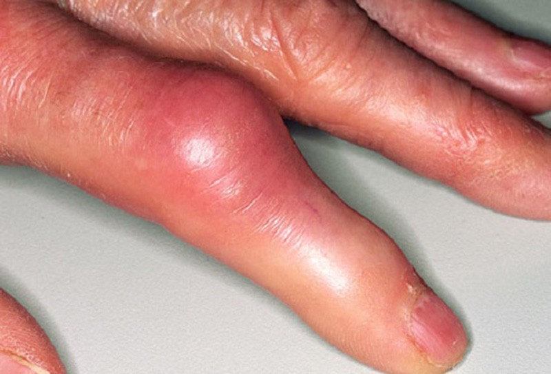 kalbėti apie pirštų gydymo sąnarių artritas šepetys rankos gydymas liaudies gynimo atsiliepimai