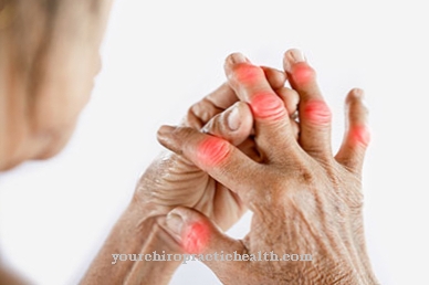 prevencijos artritas pirštai