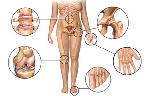osteochondrozė pėdų
