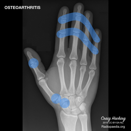 artritas phalanx finger ranku riesu skausmai