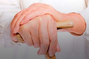 gydymo iš piršto sąnarių reumatoidinis artritas tyrimas