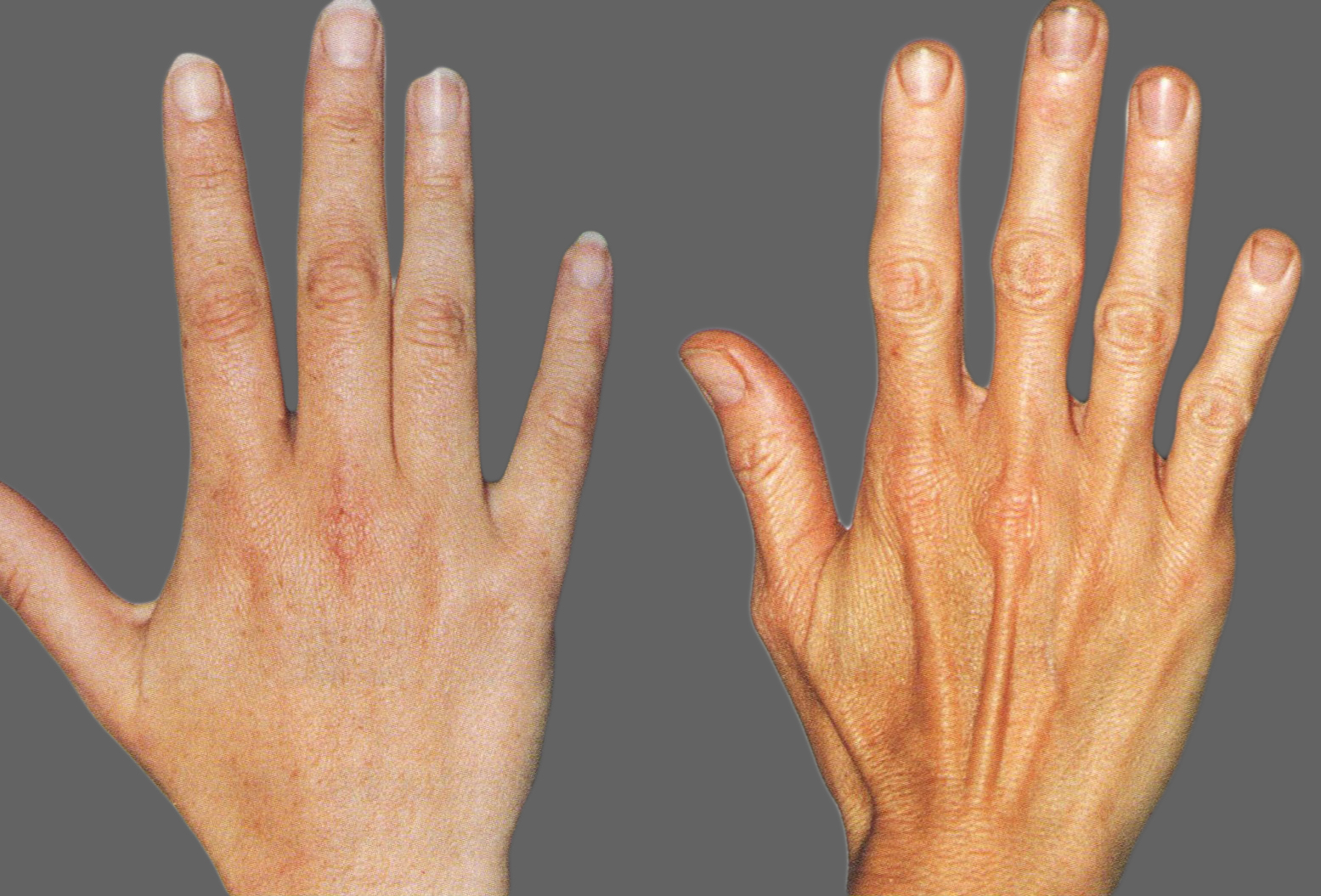 artrozės šepečiai ranka sukelia gydymas