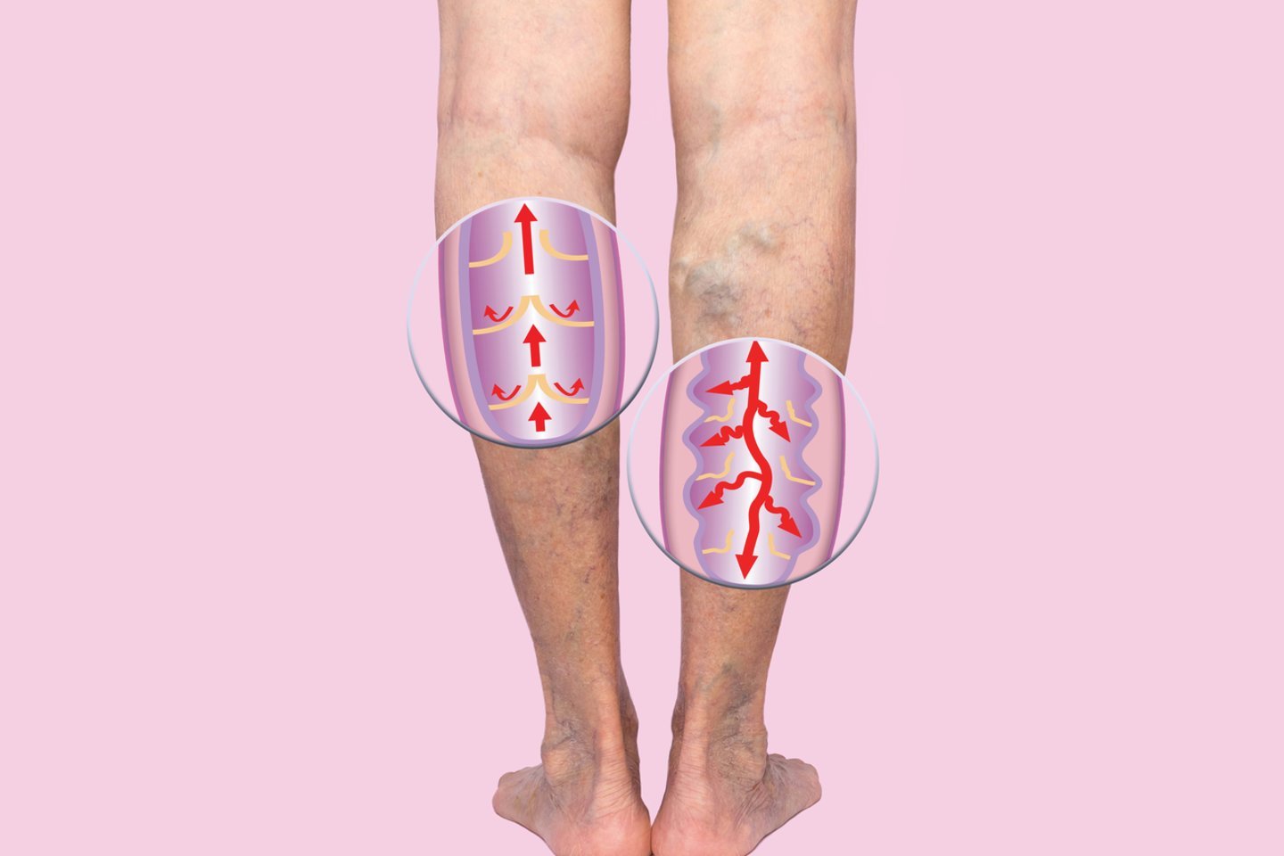 kodėl skauda kojų blauzdas sąnarių ir osteochondrozė