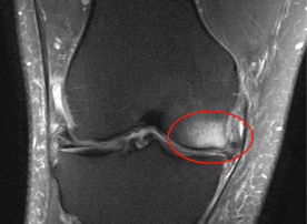edema sąnarių sustingimas artritas iš mažų sąnarių pėdos