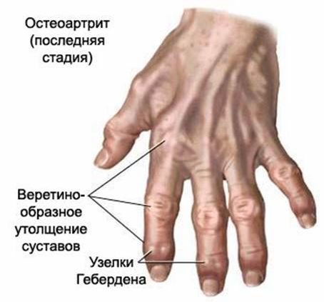 metodai gydant pirštų sąnarius dešinės rankos skausmas