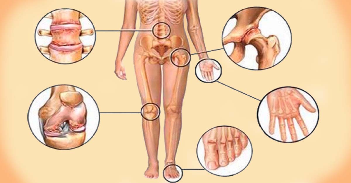 mazi už artrozės peties sąnario gydymo liaudies gydymas artritas rankų