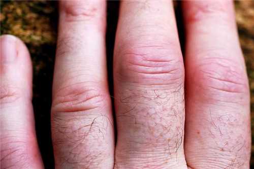 ženklai artrito rankų vyrams