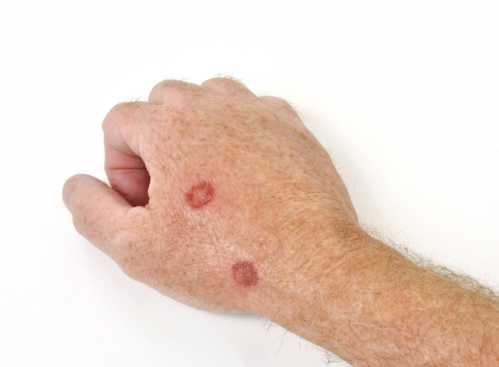 odos ligos ant rankų artritas rankos