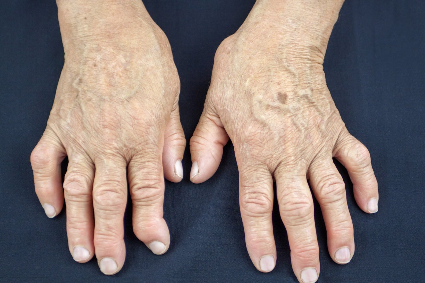 artritas kas tai per liga žolė nuo ligų sąnarių