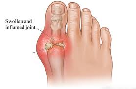 swollen painful toe joints išnirimas peties sąnario gydymo pirmosios pagalbos