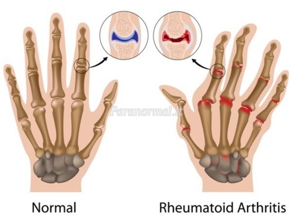 reumatoidinis artritas 3 laipsnių rankas kaip artrito gydymui stacionarinių