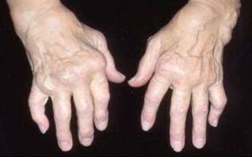artrito rankų poveikis