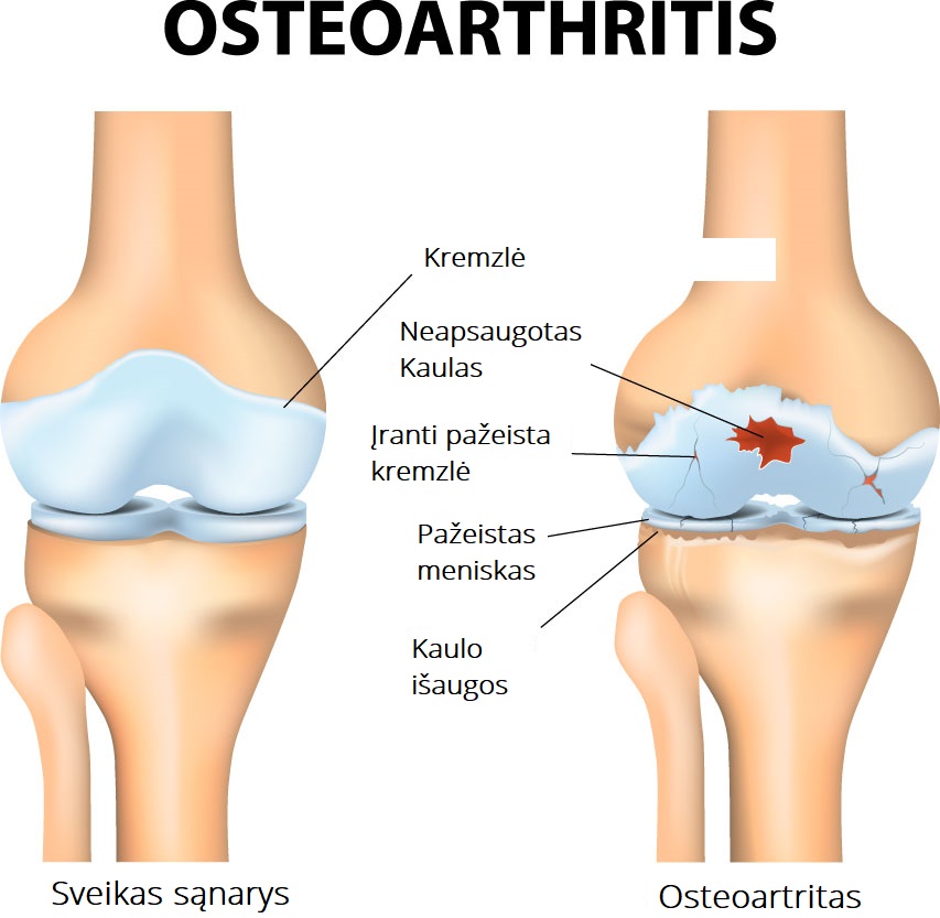 osteoartritas sąnarių gydymas tepalas stiprus sąnarių
