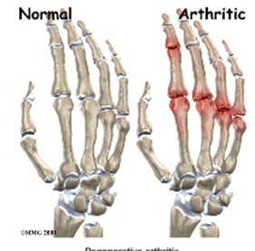 artritas phalanx finger gydymas bendrų enthesopathies