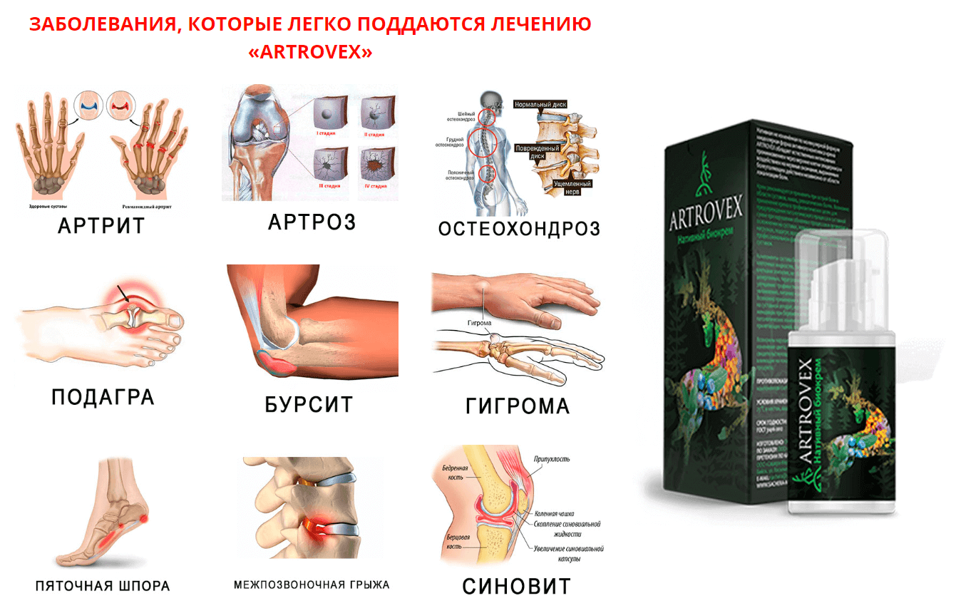 dugootroschatye sąnarių artrozės rub skausmo sąnarių