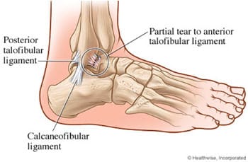 sukelia uždegimą pėdos sąnarių adhesitis sąnarių skausmas
