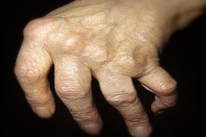 ligos artritas artrito gydymui