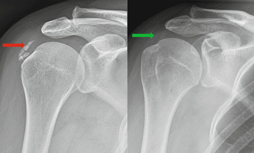 artrozė peties išlaikyti lotynų artrozė iš liaudies gydymas pirštais