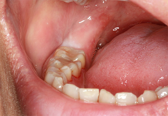 išmintis dantis skauda sąnarius ledo paveikslai sąnarių skausmas