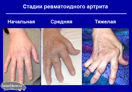 rankų falangi artritas kaip atsikratyti sąnarių skausmas ir raumenų