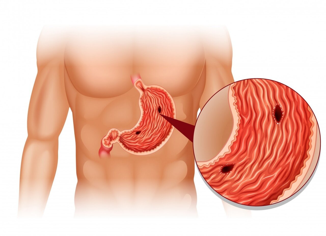 gydymas skrandžio-žarnyno sąnarių skausmas krutines lastoje kaireje puseje