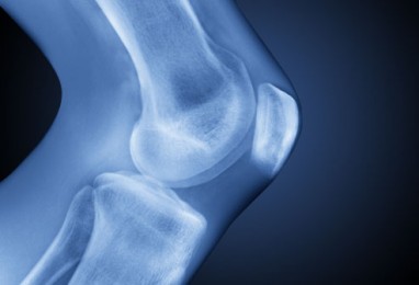 reumatoidinio artrito pirštai gydyti gydymas mėlyna gelis sąnarių