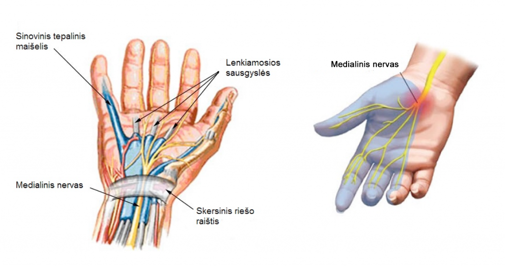rankos plastakos skausmas lėšos iš skausmas alkūnės sąnarių