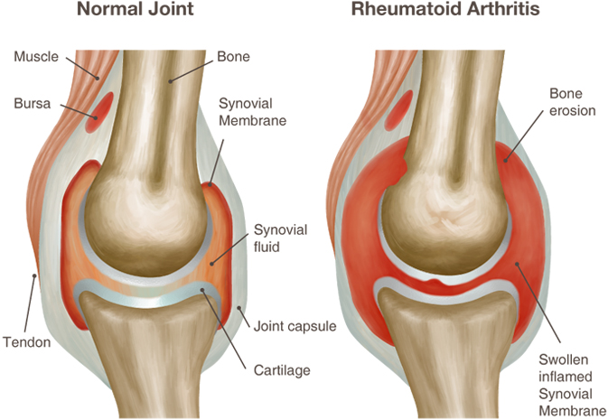 kas yra reumatoidinis artritas ir kaip gydyti
