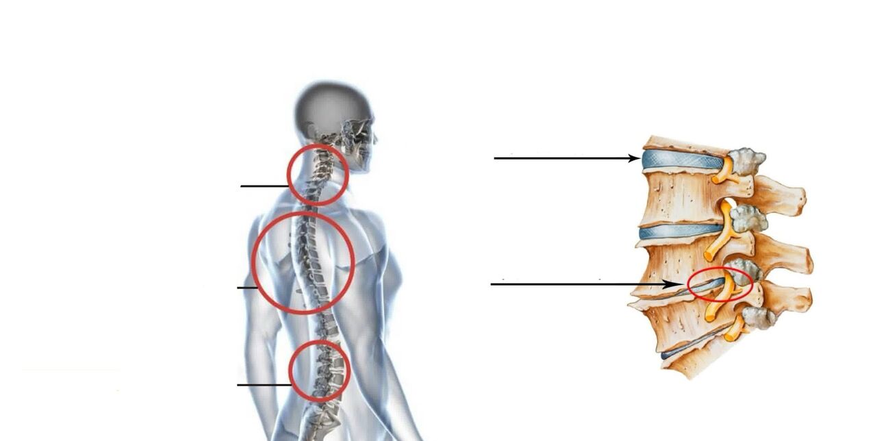 osteochondrozė iš šlaunikaulio sąnarių gydymas artrozė dviratį