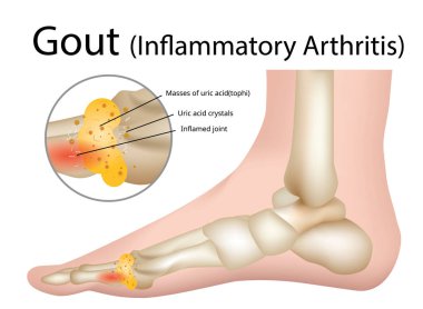 podagra tratament natural ką ir kaip gydyti artritą