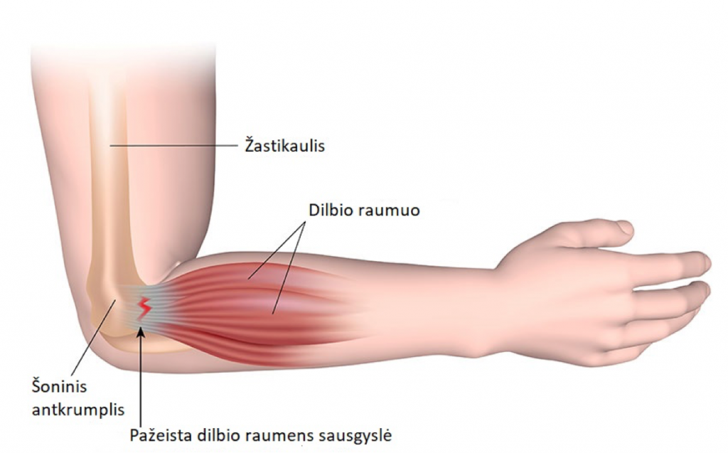 alkūnės sąnario skausmą kai plėtinys paviršiai virš pėdos