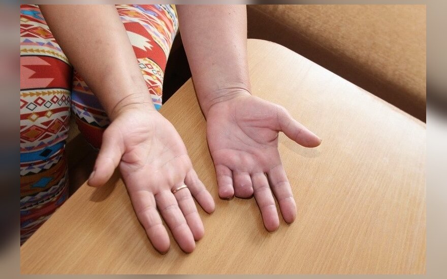 sąnarių mažai pirštus ant rankų kaip atsikratyti artrito rankas