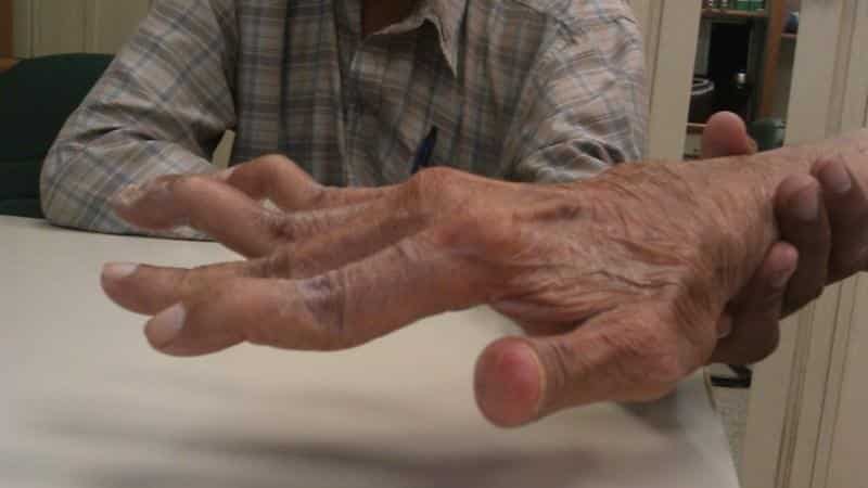 artritas dulkių nykščio jei pakabinti šlaunikaulio