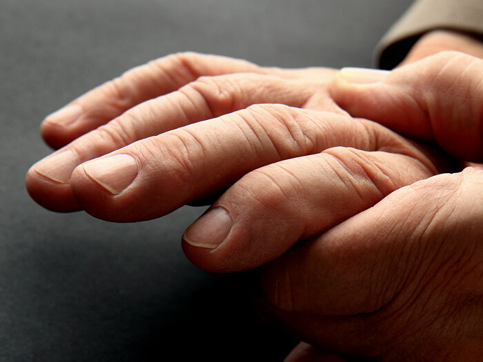 swollen painful finger joints morning artritas iš snukio ženklų sąnarių