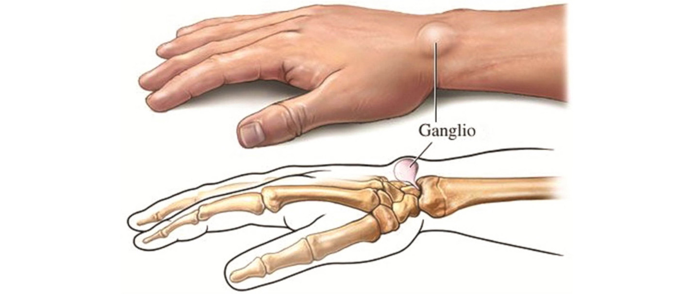 rankos zasto skausmas kaip sukurti ranką artritu