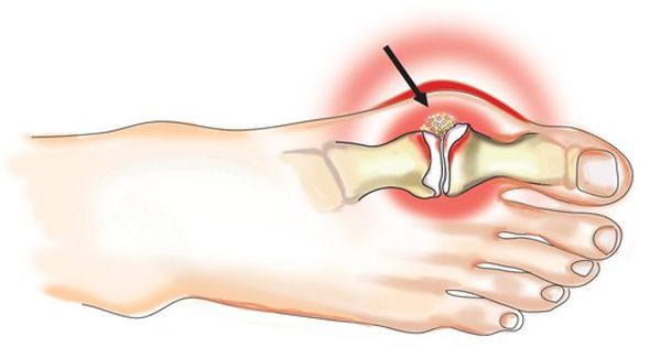 poliartrito sąnarių reumatoidinis artritas