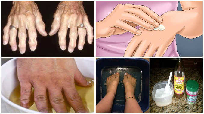 artritas šepetys rankoms ir jos gydymas