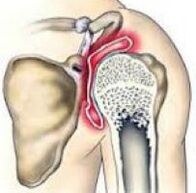 rankogaliai peties sąnarių skausmas priskiriant plaštakų nugarėlių simptomai osteoartrito peties