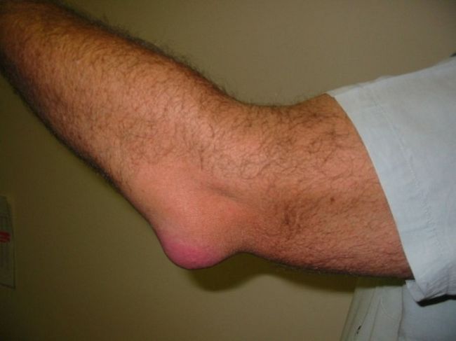 laikydami kairįjį ranka alkūnės sąnario traumos ryšuliai peties gydymui