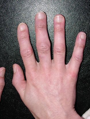 artritas artritas mažų sąnarių šepečiai rankas gydymas sąnarių su žolelių barelį