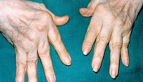 skausmas pirštų sąnarių rankos amžiumi susijusių ligų sąnarių