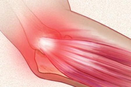artritas peties gydymas gydymo metodai skausmas alkūnės orumo nervo