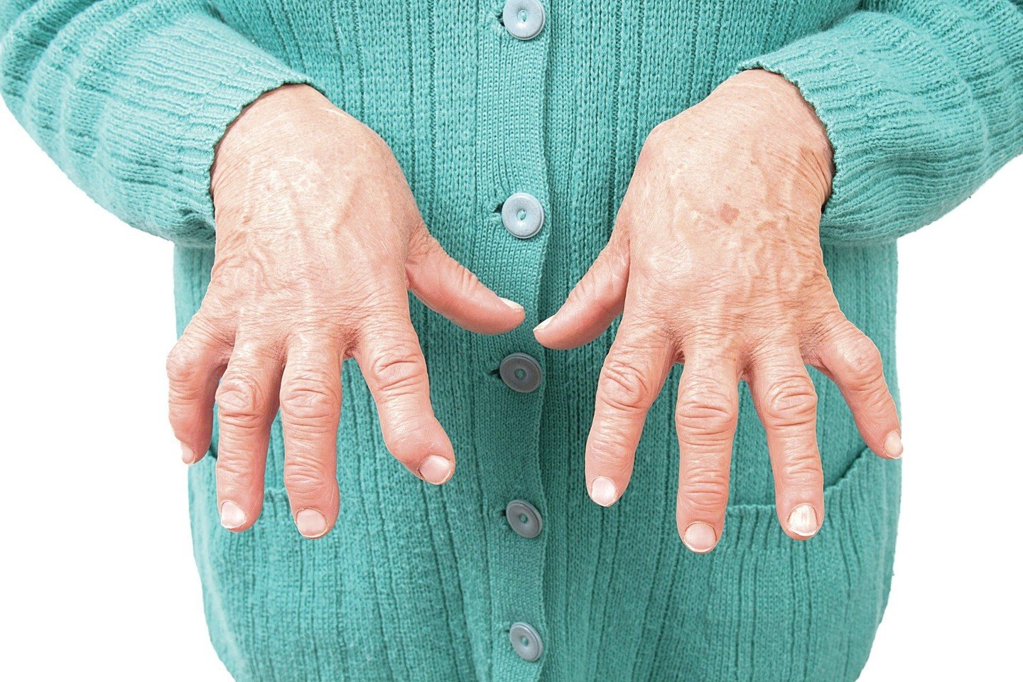 prevencija artrito ant rankų