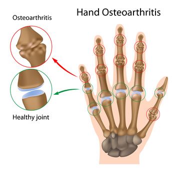 gydymas pečių osteoartrito