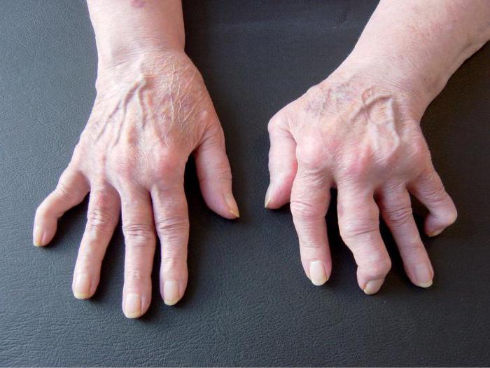 artrozė iš pėdos ir gydymo sąnarių uždegimas sąnarių reumatoidinis artritas
