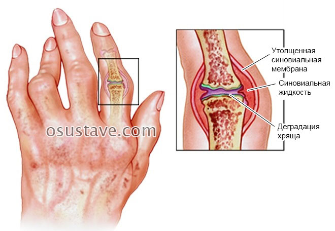 artritas 5 fingers šepečiai