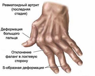artritas falanga pirštai